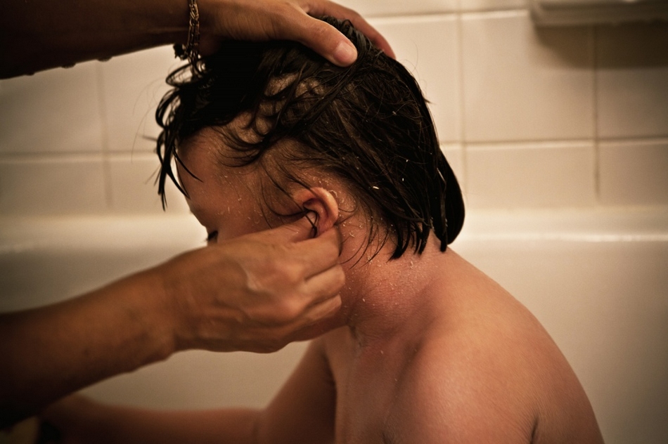 孤兒?。呼~(yú)鱗病女孩的艱難生活【圖】